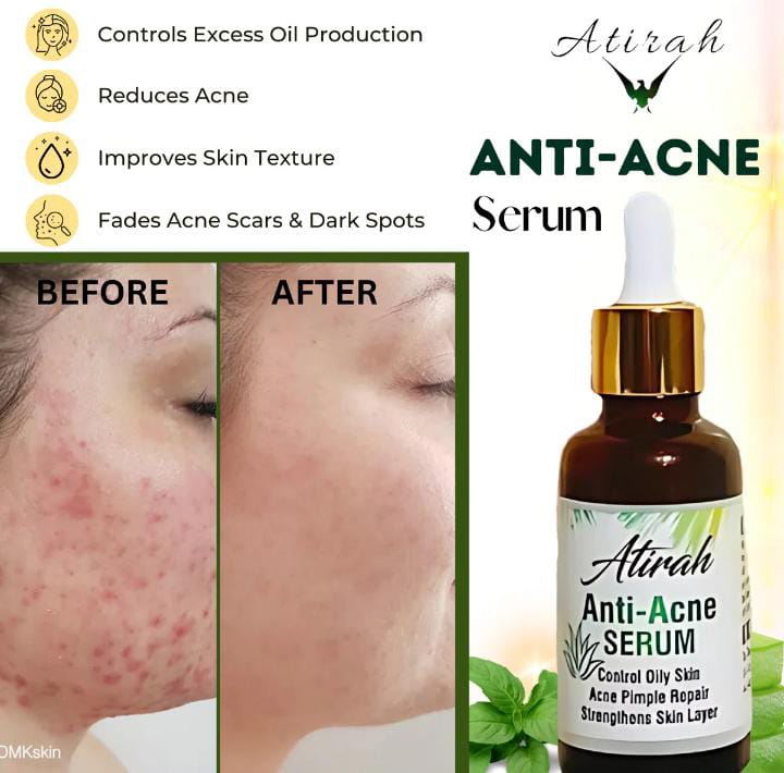 Anti Acne & Glowing Serum – Vitamin C + E